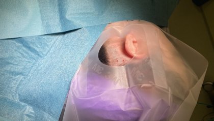 IMPLANTAAT HELPT EPILEPSIEBEHANDELING