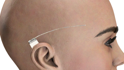 Behind-the-ear electrode measures EEG for better treatment of epilepsy