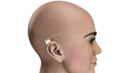 Behind-the-ear electrode measures EEG for better treatment of epilepsy
