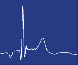 Averaged result for the Magneto Cardio-Gram (MCG) of an adult heart