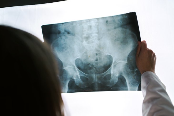 Onderzoeker Universiteit Twente analyseert heupfractuur op röntgenfoto met AI-ondersteuning