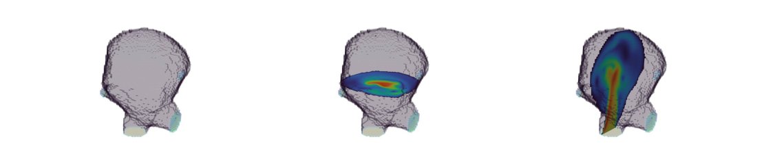 Figure 1: Aneurysm model showing a snapshot of the velocity field in two cross-sections, resulting from pulsatile flow.