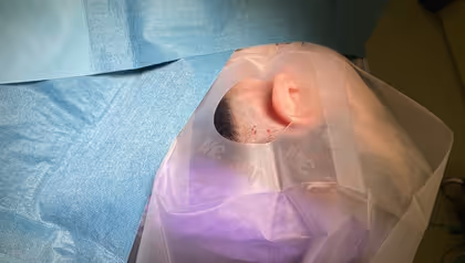 IMPLANTAAT HELPT EPILEPSIEBEHANDELING