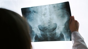 University of Twente researcher analysing hip fracture on X-ray with AI support