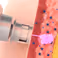 1 april 2025 Injecties zonder naalden