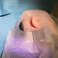 IMPLANTAAT HELPT EPILEPSIEBEHANDELING