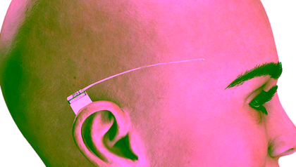Behind-the-ear electrode measures EEG for better treatment of epilepsy